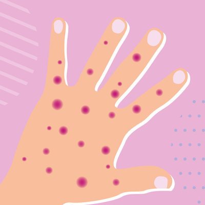 الأمراض المعدية في الوقت الحقيقي PCR Monkeypox Test Kit MPXV CE مسجل 1 اختبار / صندوق